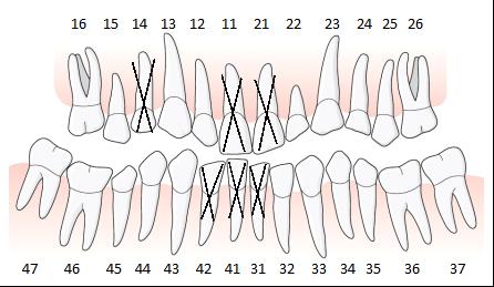 På vänster sida har tänderna 35 och 36 elongerat. Detta har medfört att ocklusionsplanet har en kraftig lutning och det kommer inte att vara möjligt att få en fungerande artikulation mot överkäken.