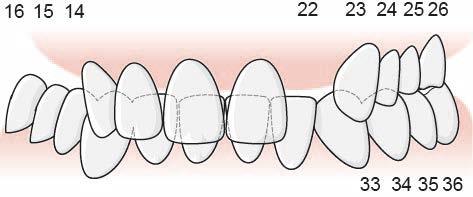 114 6.5.3.4.1 Exempel, tillstånd 5071 fastställs för båda tänderna i ett antagonerande tandpar En patient har i höger överkäke inga tänder kvar bakom 13 och i vänster överkäke finns en entandslucka 22.