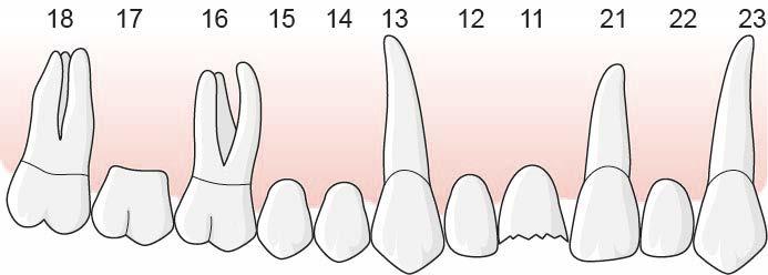 Tandläkaren fastställer tillstånd 5031 för entandsluckan 15 och rapporterar åtgärd 801 x 2 