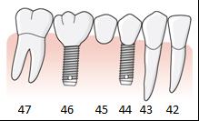 129 Om friändstandlöshet skulle föreligga vid samtliga exempel i bilden ovan, det vill säga 7:or och 8:or saknas, skulle tandvårdsstöd lämnats för likadana konstruktioner.
