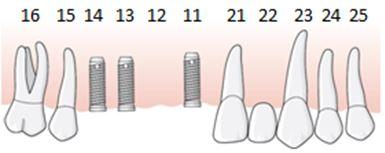 149 6.7.7.5.3 Exempel, långtidstemporär konstruktion på implantat behöver utföras i väntan på kompletterande operation En patient har en fyratandslucka 14 11.