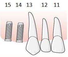 155 Tandläkaren fastställer tillstånd 5447, Implantatkonstruktion i helt tandlös käke. Tandläkaren föreslår att ytterligare två implantat installeras och att en hel implantatbro utförs.