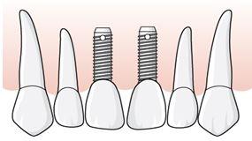 En tvåtandslucka, tillstånd 5033, finns eftersom regel E.11 anger att befintliga implantat ska likställas med tandlöshet när tillstånd ska fastställas.