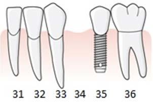 164 14 och 15. Tandläkaren fastställer tillstånd 5035, Fyra-eller flertandslucka, se regel E.11. Sinus utsträckning medför att benmängden är begränsad.