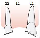 175 Patienten får därför provisoriska kronor för 12 och 21 under behandlingstiden. När implantatet i tandposition 11 opereras in lämnas tandvårdsersättning för utbytesåtgärd 925.