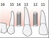 När tandläkaren utför kronorna lämnas tandvårdsersättning för utbytesåtgärd 926 för implantatkronan 11.