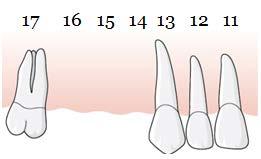 Om det finns två separata tandluckor i samma käke kan de inte läggas ihop utan