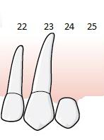 Tandläkaren fastställer tillstånd 5012, Enkelsidig friändstandlöshet där samtliga tänder i position 4 8 saknas. Tandläkaren föreslår att det hängande ledet 24 tas bort.