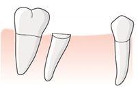 Tanden 46 har en djup vertikal ficka mesialt och 47 har en konisk rot med viss marginal bennedbrytning.