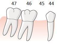 97 6.5.1.2.6 Exempel, tand i position 5 saknas, mesiala roten av tand i position 6 avlägsnas, entandslucka position 5, endast ett hängande led behövs En patient har en entandslucka 45.