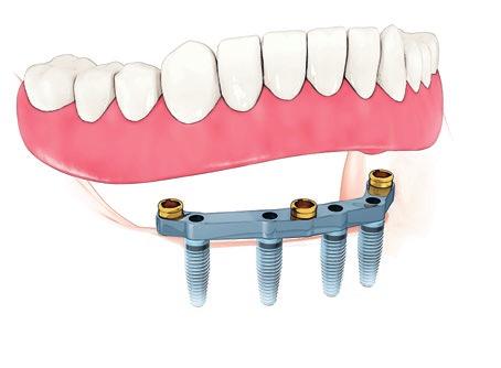 implantat