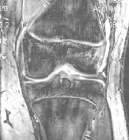 Laurencikas, MRI