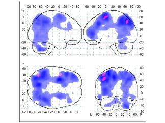 Hjärnregioner viktiga för att lösa de matematiska uppgifterna Skillnader mellan AR och CMR inom de regioner som är viktiga för matematik Flera stora regioner (blå) relateras till matematisk