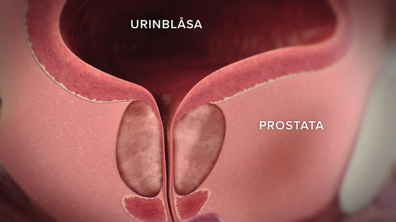 BPH - benign prostatahyperplasi Godartad prostataförstoring (BPH) kan orsaka uttalade svårigheter att kasta vatten.