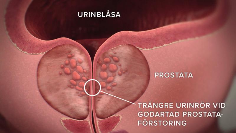 BPH är inte någon cancersjukdom men kan obehandlad leda till allvarliga skador på urinblåsan och/eller njurarna med bestående funktionsnedsättning.