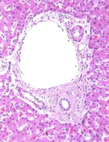 Identifiera strukturerna i en porttriad 1-3: H=leverceller S=röda blodkroppar i leversinusoider 1) gren av leverartären tjock vägg 2) gren av portvenen skivepitel 3) Gallkapillär - kubiskt epitel d.