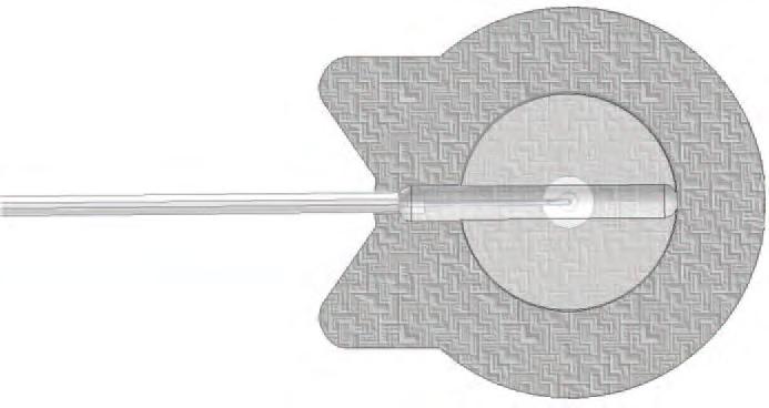 AVSNITT 15 INFUSIONSSET Du bör använda ett infusionsset med följande egenskaper: reducerad invändig slangvolym (optimalt 0,1 ml, max. 0,62 ml); högst 90 cm lång slang; slang utan veck.