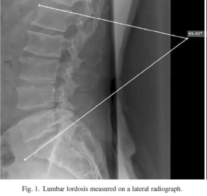 METOD SPINAL ALIGNMENT Spinal