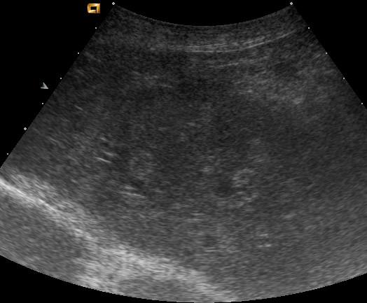 I Figur 5 nedan ses en kraftigt förstorad höger njure vilken innehåller multipla fokala och konfluerande anechoiska till hypoechoiska strukturer, vilket mest sannolik representerar cystiska