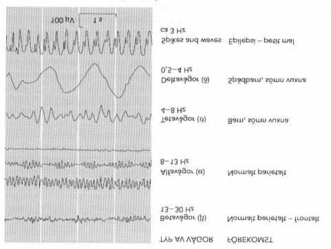 Medicin och Teknik, Bertil Jacobsson, 1995 Betavågor har en högre frekvens (13-30 Hz) och uppträder normalt över hjässloberna (temporalt) och över pannloberna (frontalt).