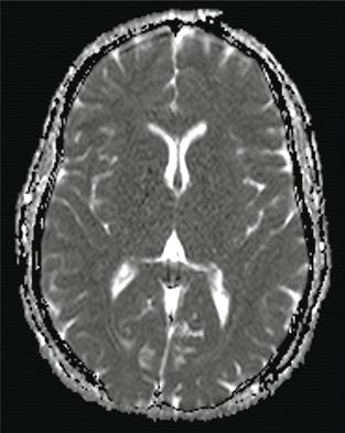 Ischemiska/anoxiska skador i hjärna efter hjärtstopp visualiserade med datortomografi. Till vänster: normal bild; till höger: cytotoxiskt ödem med utplånad skillnad mellan vit och grå substans.