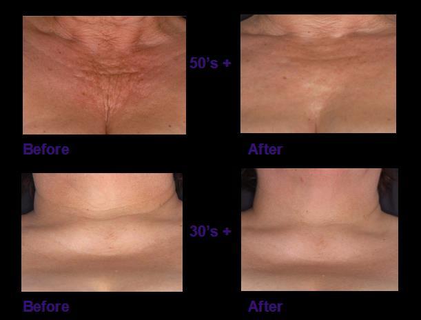 Anti-Ageing Pro-Collagen Lifting Treatment Neck and Bust Ref: 2200289 Den här kraftfulla creamen för dekolletage och hals har en kliniskt bevisad förmåga att förbättra hudens struktur med upp till 33
