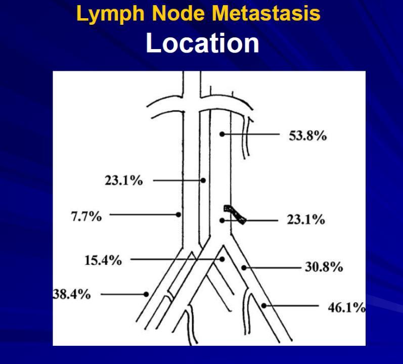 Risk för lymfkörtelmetastaser vid endometriecancer >50%