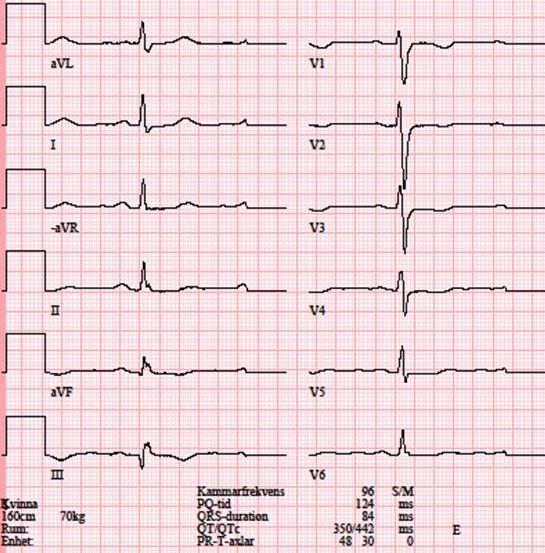 4 Vilo-EKG