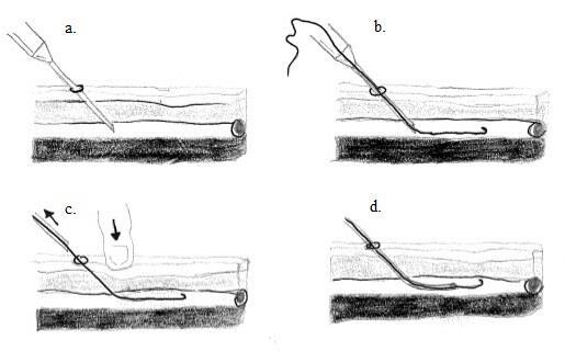 a. Blodkärlet punkteras med punktionsnål b. Ledare förs in c. Nålen plockas bort d. Kateter förs in över ledaren i blodkärlet Figur 3.