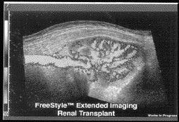 Figur 6. Njurtransplantat med tillförande artär, visat med tvådimensionell bild och energidoppler. Med denna teknik kan man framställa flödet oberoende av dopplervinkeln.