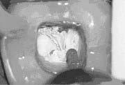 3) Metall restorationer Arbetsdelen av Transmetall borret användes initialt för att skära ett mindre fönster genom metall.