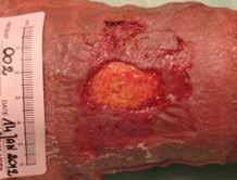 med svårläkta, venösa bensår där sannolikheten för biofilm var