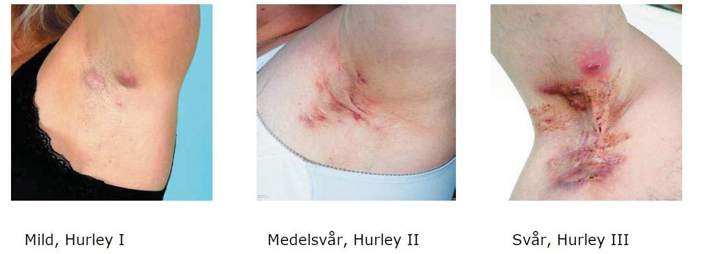 2. Återkommer bölderna på samma lokal? 3. Röker du eller använder du andra tobaksprodukter? 4. Aktiveras dina bölder före mens? 5. Har behandlingen du fått haft effekt? 6.