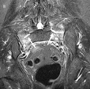 Skånska erfarenheter Inspirerade av erfarenheterna från Oxford infördes 2007 i samarbete mellan ortopedi, allmänmedicin och radiologi på sjukhuset i Ängelholm ett kortprotokoll som