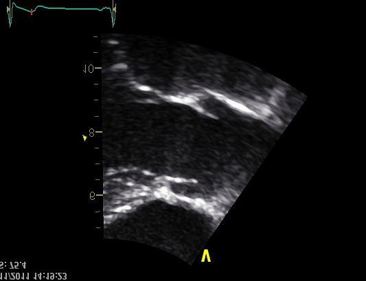 2 (6) Beräkningsformler för slagvolym (SV) och slagvolyms index (SVI): SV (ml) = π x (D 2 /4) x VTI där D = LVOT- eller RVOT-diameter (cm); VTI = velocity time integral i LVOT eller RVOT (cm) SVI