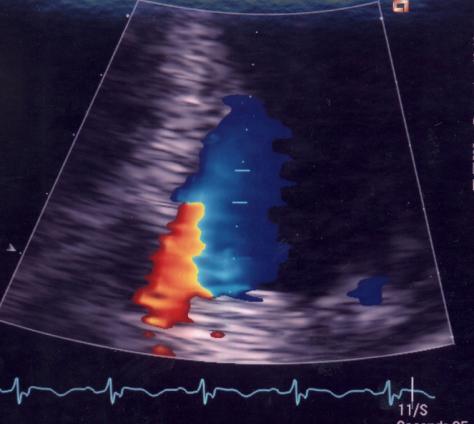 5 (6) 2 3 1 1 2 3 Figur 4. Färg-Doppler i LVOT (vänster) visar den subvalvulära accelerations-zonen (ljusblått) som bör undvikas för att erhålla optimal Dopplersignal.