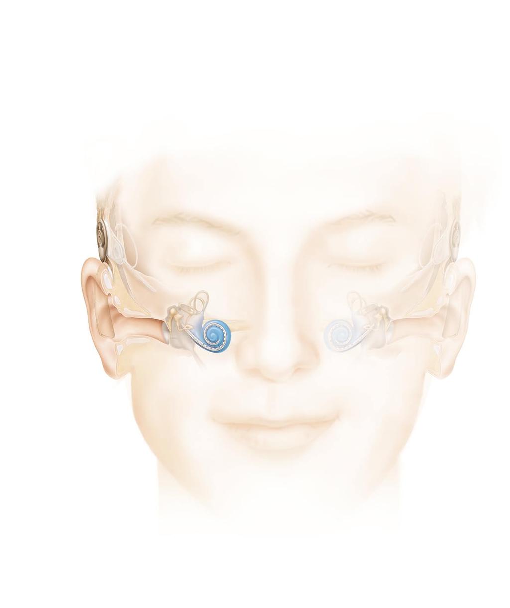 Vad är ett cochleaimplantat? Cochleaimplantatet är utformat så att det ger optimal taluppfattning, men det återger också omgivningsljuden på ett bra sätt.