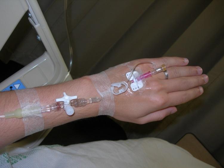 Terapi Steg 1 Vätskeinfusion. Ringeracetat.