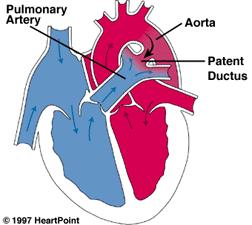 Öppetstående ductus arteriosus