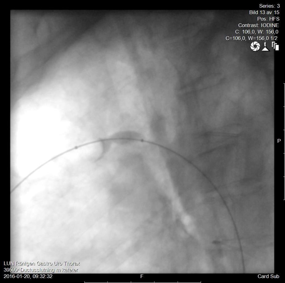 Öppetstående ductus arteriosus (PDA) 80 årig kvinna