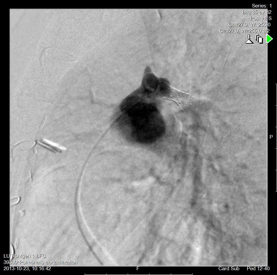 Fallot och perifer pulmonalisstenos, kvinna född 94 Inkommer med grav cyanos och hemoptys Coiling av aortopulmonell