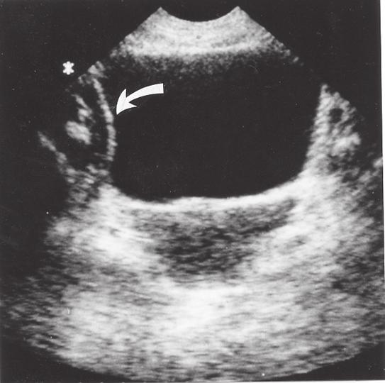 första trimestern dating ultraljud noggrannhet