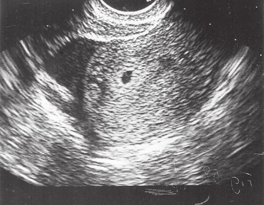 tidig graviditet dating ultraljud