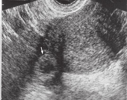 graviditet ultraljud dating noggrannhet