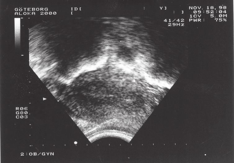 Datering av sekretoriska endometriet