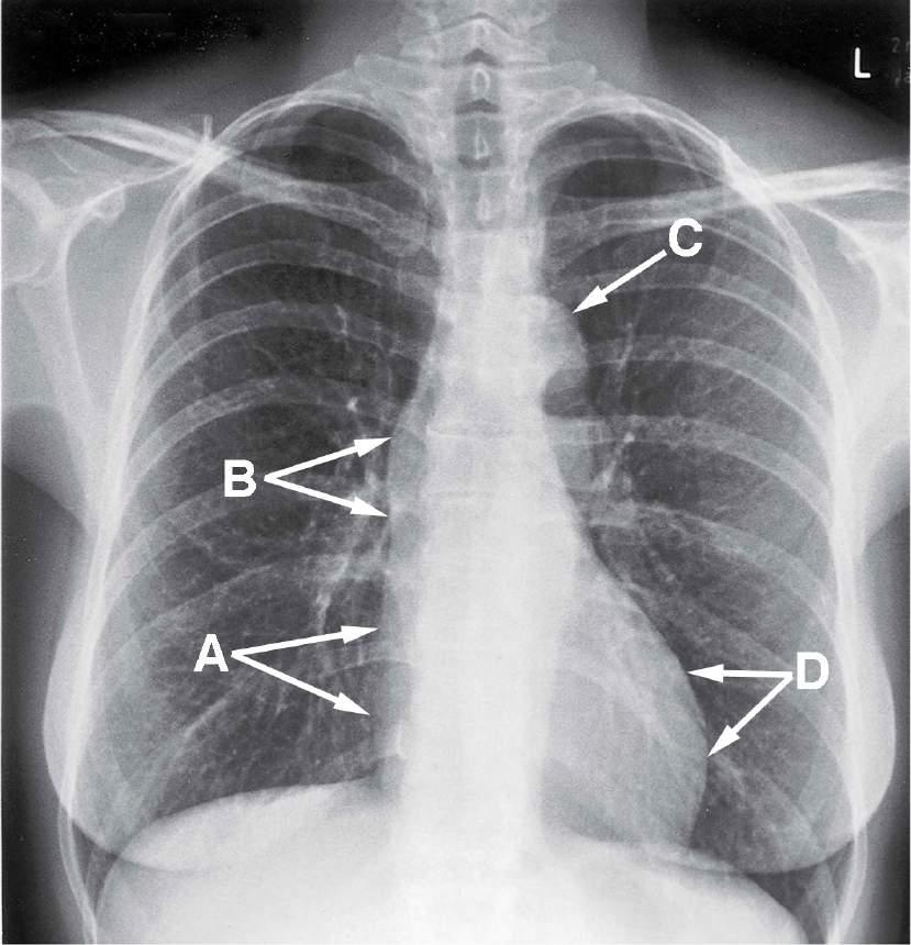 BILD HJÄRTA: Bilden nedan visar en anteroposterior röntgenavbildning av thorax. Vad heter de strukturer (latinska namn) som bildar de konturer som indikeras med A-D (100212ORD, 2p) A: Atrium dx. B: V.