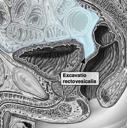 PELVIS: M. piriformis, två bendetaljer på Os coxae och två ligament mellan Sacrum och Os coxae bildar Foramen ischiadicum maj. och min. samt Foramen supra- och infrapiriforme.