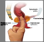 Funktionella anorektala sjukdomar Fecal incontinence Functional anorectal pain Levator ani syndrome 6 mån; 2 4 episoder med FI under 4 veckor