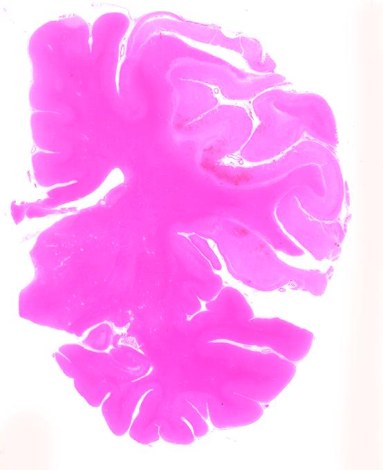 Stroke