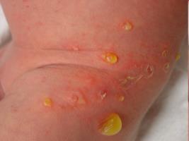 i behandling av impetigo inte